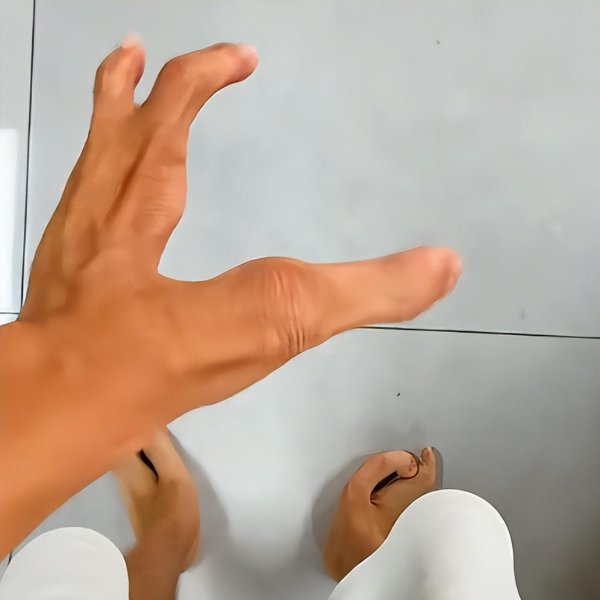 银河策略 因外公外婆是堂兄妹近亲结婚，90后小伙先天“龙虾手”